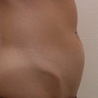 Liposuccion de l'abdomen avant