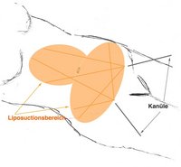 Liposuctionsbereich, Kanüle