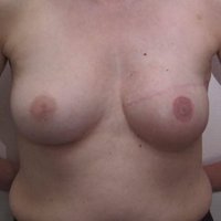 Reconstruction du sein après cancer après
