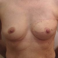 Reconstruction du sein après cancer après