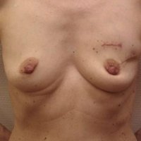 Reconstruction du sein après cancer avant