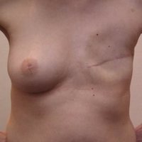 Reconstruction du sein après cancer avant