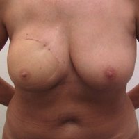 Breast reconstruction after