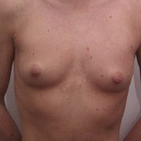 Breast Augmentation before