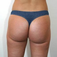 Liposuction after