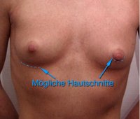breast augmentation incision