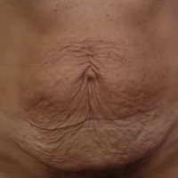 Abdominoplasty before