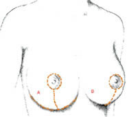 scar breast reductions